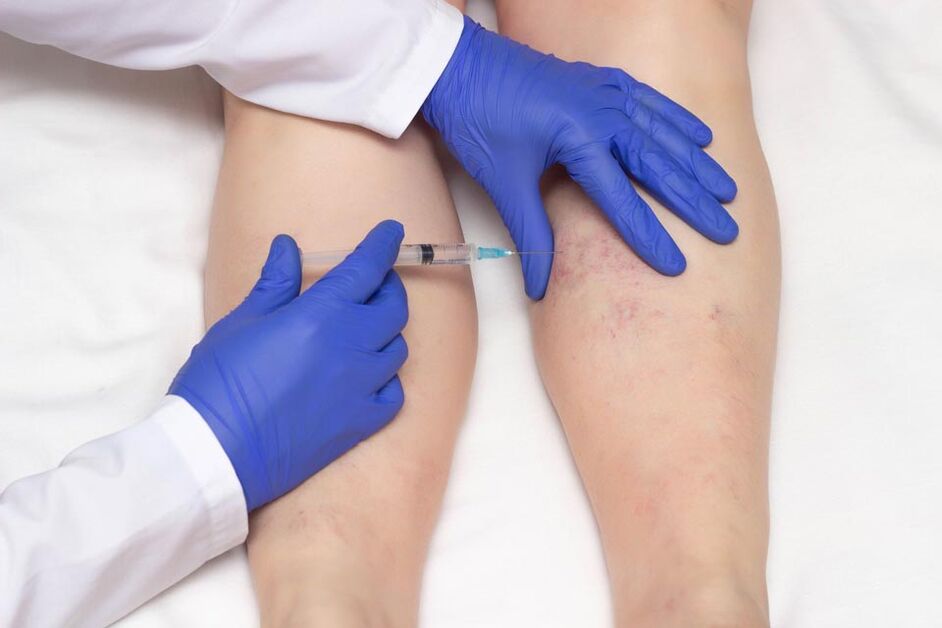 Skleroterapia je metóda liečby kŕčových žíl