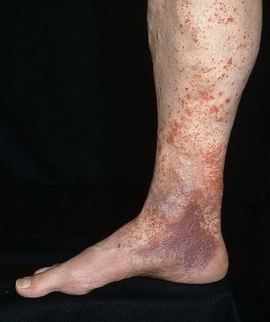 Dermatitída