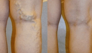 príznaky a príznaky kŕčových žíl na nohách u mužov