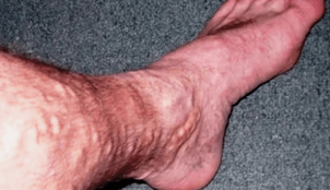 príčiny kŕčových žíl na nohách u mužov
