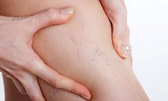 dôvody pre rozvoj kŕčových žíl na nohách