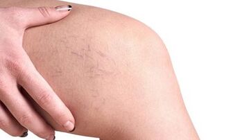 štádia vývoja kŕčových žíl