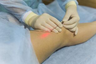 laserové ošetrenie kŕčových žíl podstata postupu