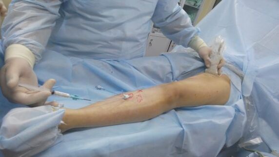 chirurgický zákrok na kŕčové žily na nohách