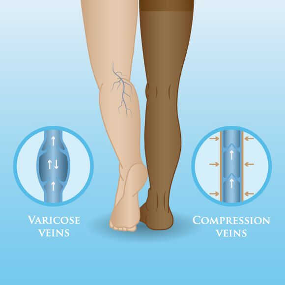 Účinky kompresného oblečenia na kŕčové žily na nohách