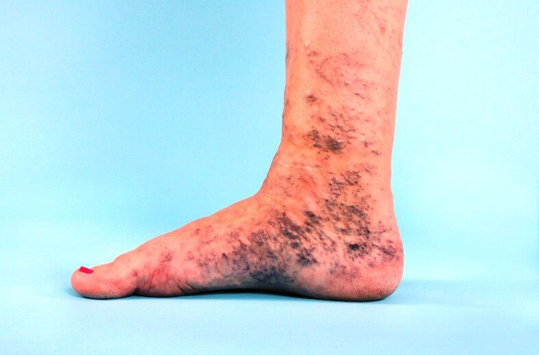 zanedbané kŕčové žily na nohe