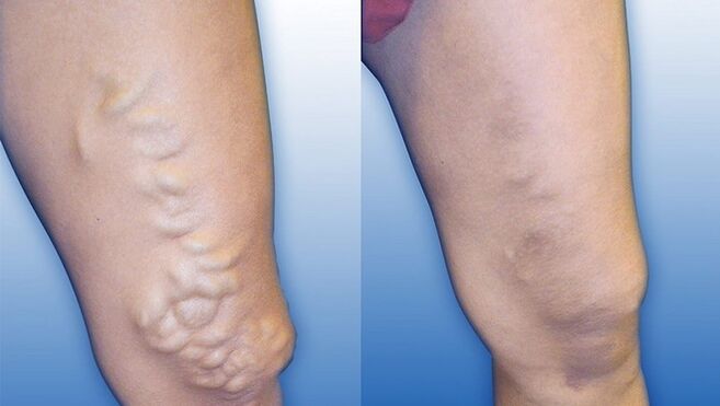 Nohy pred a po liečbe ťažkých kŕčových žíl