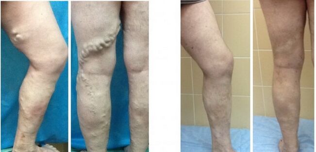 Nohy pred a po rádiofrekvenčnej obliterácii žíl s kŕčovými žilami