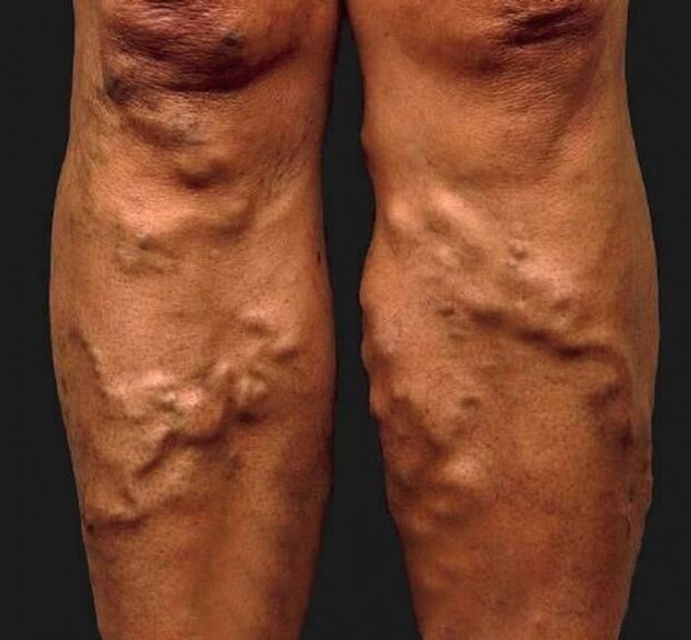 zanedbané kŕčové žily na nohách
