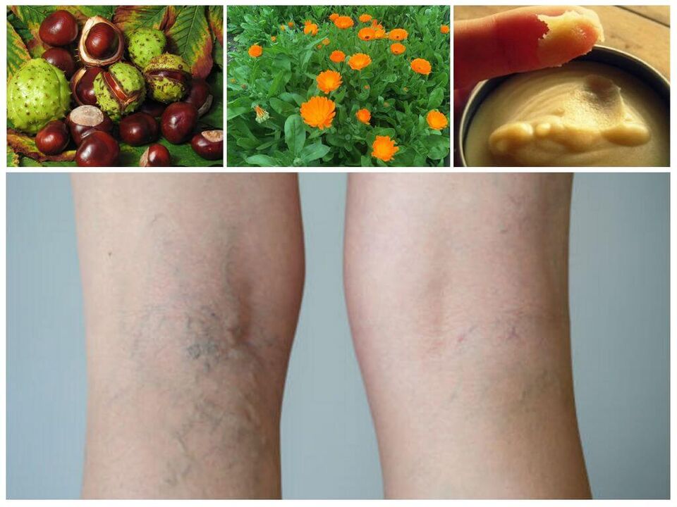 kŕčové žily na nohách a ľudové prostriedky na ich prevenciu