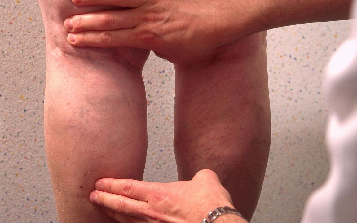 lekár vyšetrí nohy s kŕčovými žilami