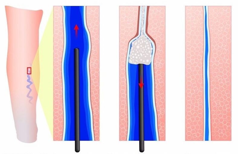 skleroterapia na kŕčové žily na nohách u mužov